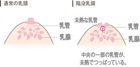 陥没乳頭(陥没乳首) の治療・治し方等